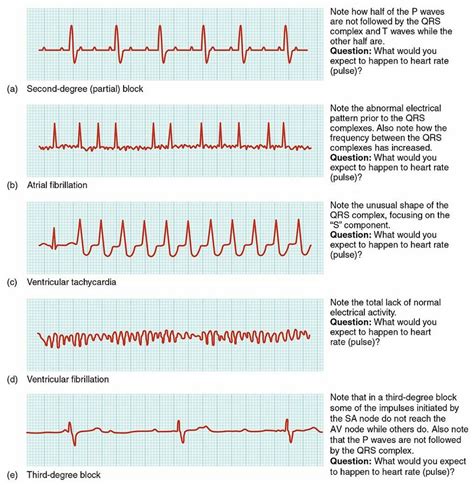 arrhythmia heart sounds